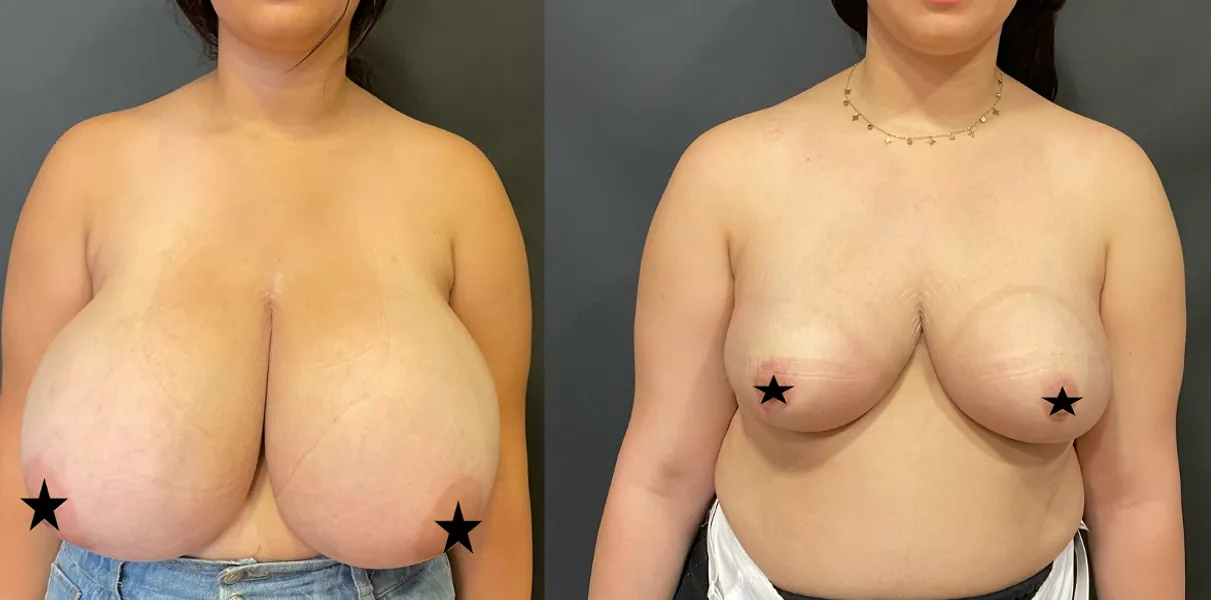 Avant et après : Chirurgie mammaire
